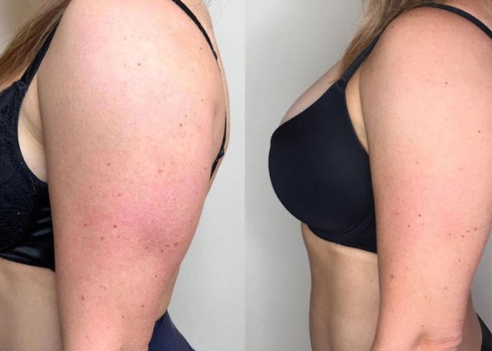 Fat freezing arms before and after at Vivo Body & Skin Clinic