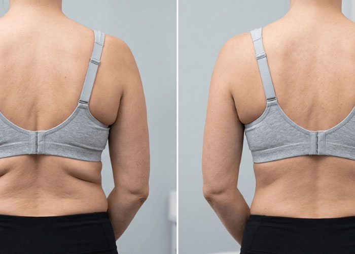 Fat freezing bra line before and after at Vivo Body & Skin Clinic