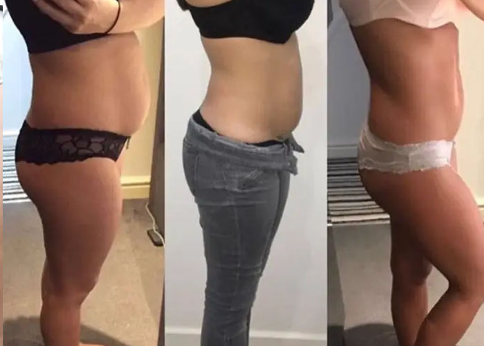 Fat freezing before and after at Vivo Body & Skin Clinic