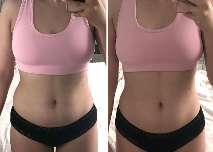 Fat freezing full body before and after at Vivo Body & Skin Clinic