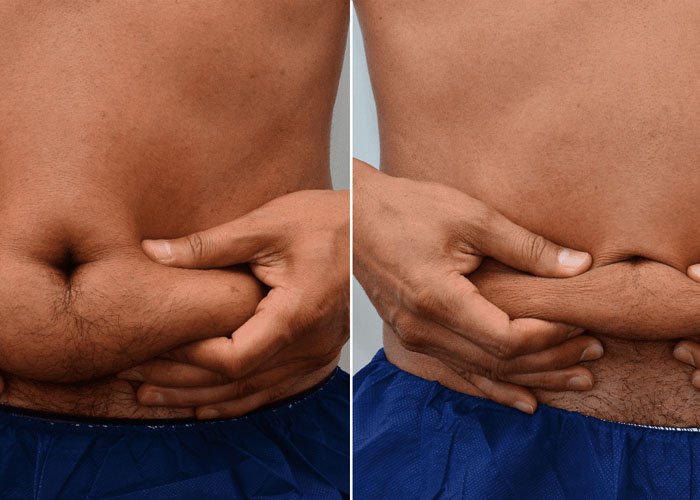 Fat freezing belly before and after at Vivo Body & Skin Clinic