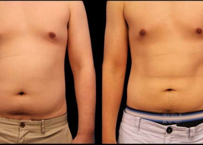 Fat freezing male chest before and after at Vivo Body & Skin Clinic