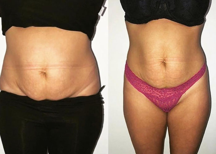 Fat freezing stomach before and after at Vivo Body & Skin Clinic
