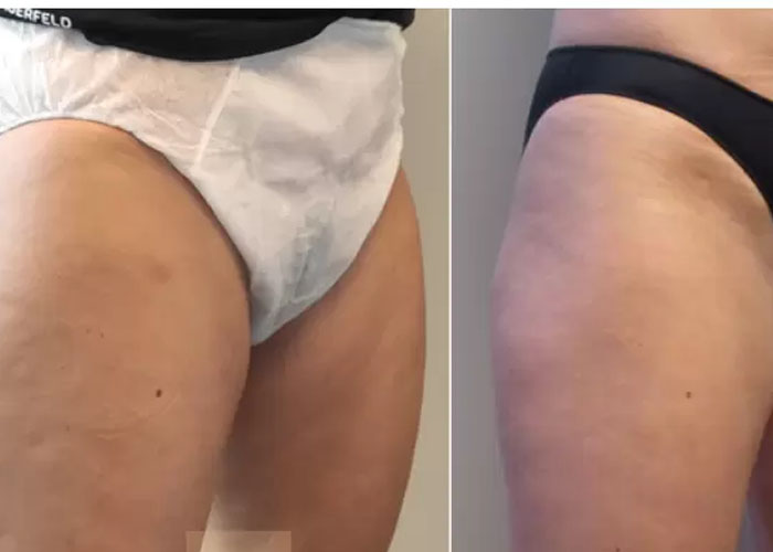 Fat freezing inner thigh before and after at Vivo Body & Skin Clinic