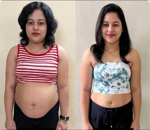 Fat freezing before and after — waistline and abdomen at Vivo Body & Skin Clinic