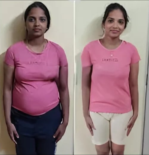 Fat freezing before and after — waistline and full body at Vivo Body & Skin Clinic