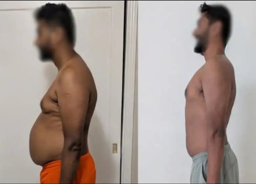 Fat freezing before and after — flank and belly side profile at Vivo Body & Skin Clinic