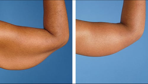 Fat freezing before and after — arms and bingo wings at Vivo Body & Skin Clinic