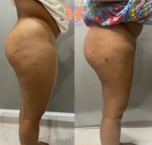 Fat freezing before and after — outer thigh and hip at Vivo Body & Skin Clinic