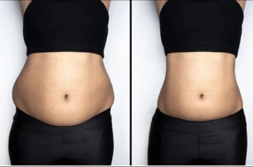 Fat freezing before and after — stomach toning at Vivo Body & Skin Clinic