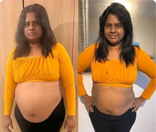 Fat freezing before and after — abdomen fat reduction at Vivo Body & Skin Clinic
