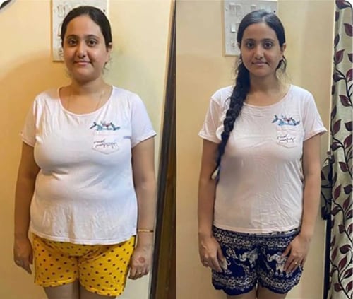 Fat freezing before and after — full body transformation at Vivo Body & Skin Clinic